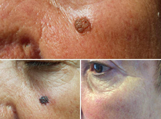 Láser Azul Blauman Nevus benignos 10