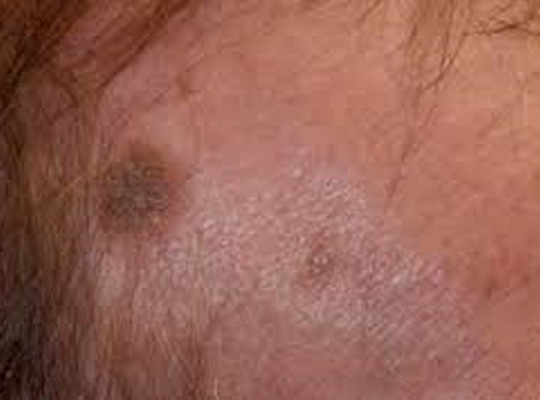 Láser Azul Blauman Queratosis seborreica 03